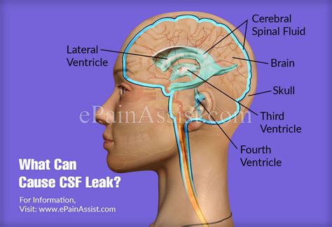 csf leak from nose test|Cerebrospinal Fluid (CSF) Leak 